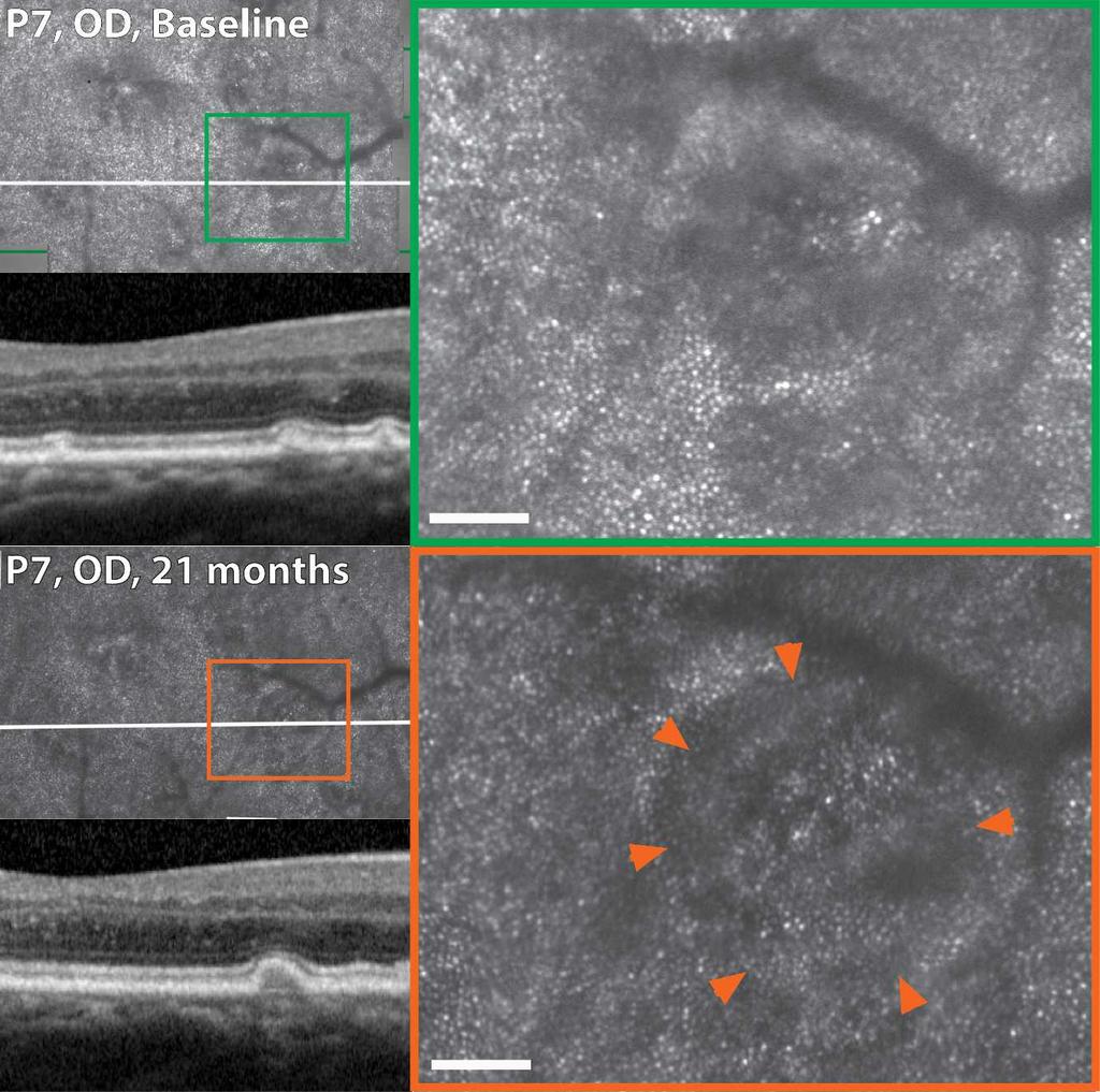 AOSLO in Eyes With Nonneovacular AMD IOVS j November 2013 j Vol. 54 j No. 12 j 7502 FIGURE 4. Morphologic features of AOSLO images from retinal areas over drusen in eyes with nonneovascular AMD.