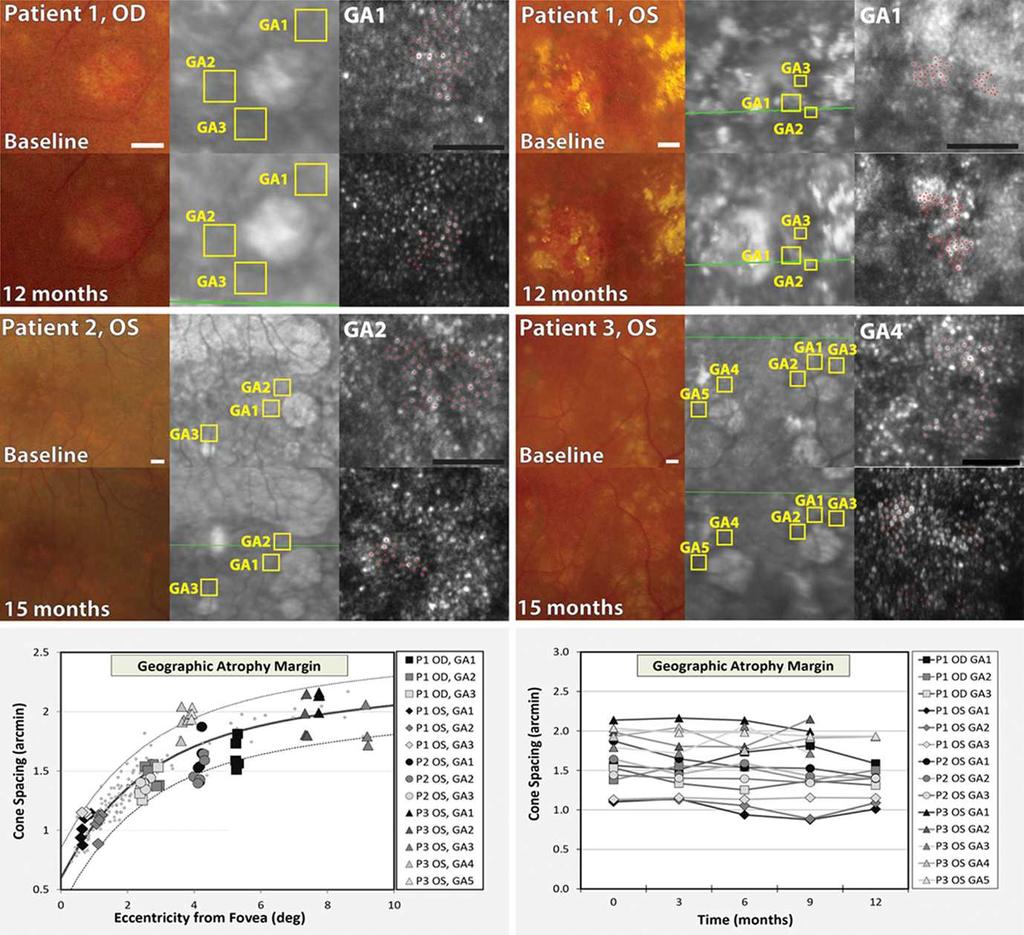 AOSLO in Eyes With Nonneovacular AMD IOVS j November 2013 j Vol. 54 j No. 12 j 7506 FIGURE 8. Cone spacing measurements in eyes with nonneovascular AMD near margins of geographic atrophy.