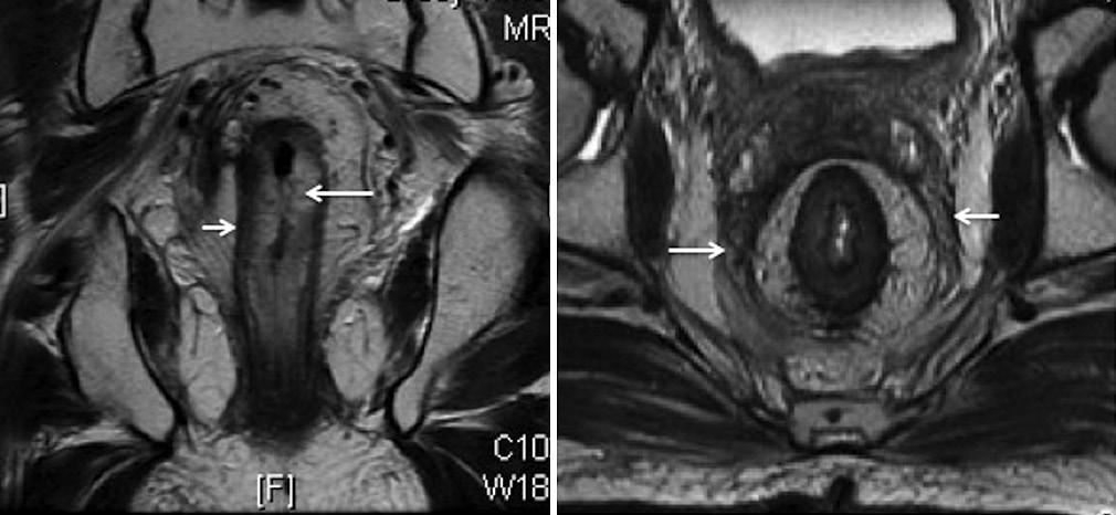 : MRI in rectal cancer DWI MRI added to T2W sequences helps evaluate the response of the primary lesion, but was less useful in predicting response in the nodes.