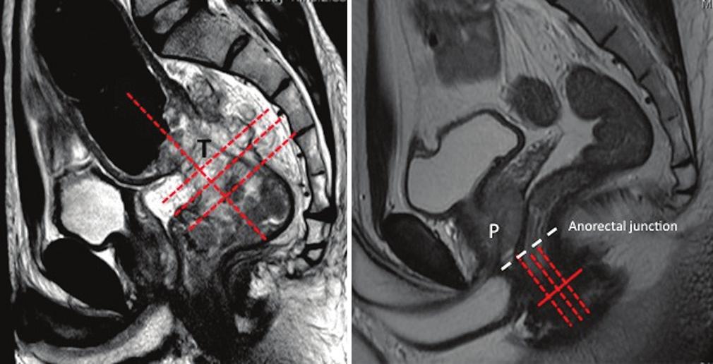 rya, et al.: MRI in rectal cancer Multidetector CT (MDCT) has been compared with MRI for local staging.