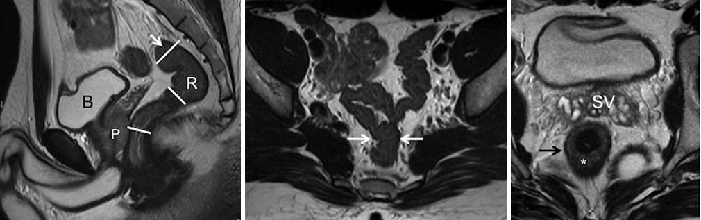 rya, et al.: MRI in rectal cancer Table 2: Imaging protocol for rectal cancer Parameter Sagittal T2W xial T2W (small FOV thin section) signal to noise ratio (SNR).
