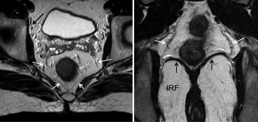 (arrows) at the level of urinary bladder dome. oth sagittal and axial images have to be viewed Figure 5 ( and ): () xial T2W MRI and () coronal T2W MRI. White arrows show mesorectal fascia (MRF).