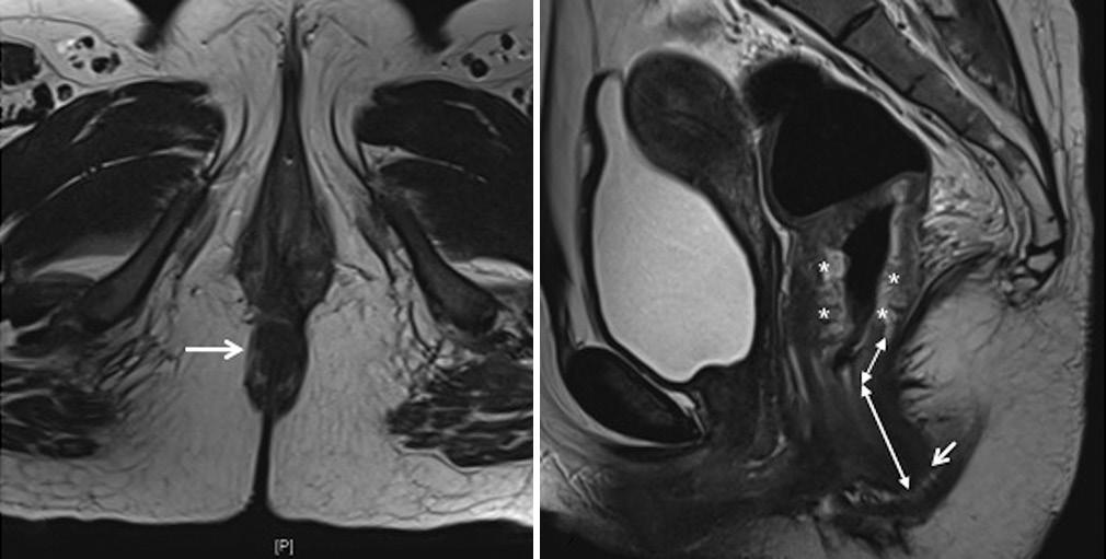 rya, et al.: MRI in rectal cancer prostate, seminal vesicles, bladder, or vagina and/or uterus. 7. Spread up to or close to lateral pelvic wall is unresectable.