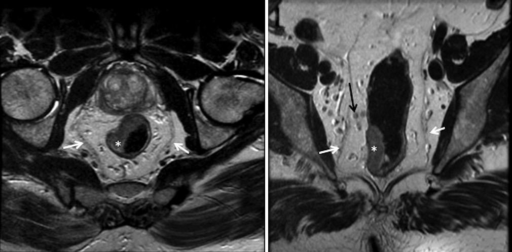 rya, et al.: MRI in rectal cancer treatment. [34] Hence, it is useful to specify the distance of extramural spread in millimeters.