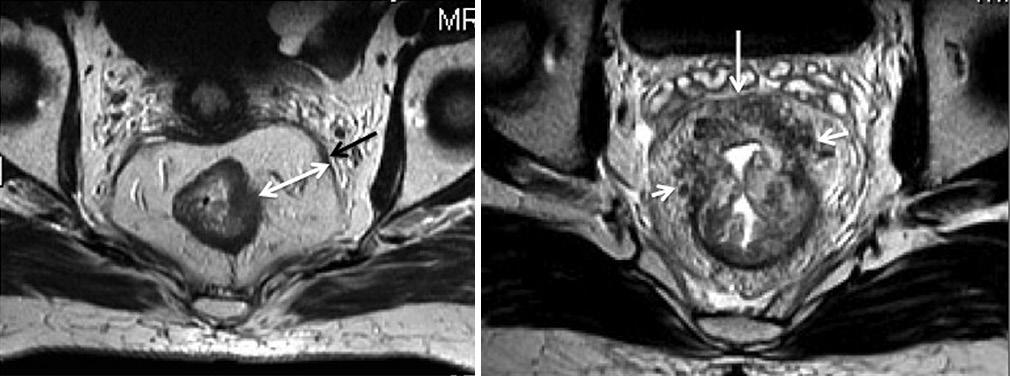 rya, et al.: MRI in rectal cancer is posterior and lateral [Figure 3]. For example, an upper rectal tumor along the anterior wall invading the peritoneal reflection will be T4a, but CRM negative.