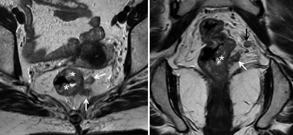 rya, et al.: MRI in rectal cancer adjuvant (postoperative) RT, though evidence is limited.