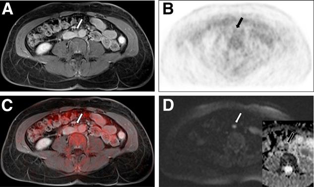 FIGURE 2. Images of 57-y-old patient with paraaortic lymph node metastasis of cervical cancer (arrows).