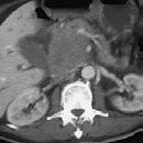 A CT scan showed a solid mass of about 3cm near the aorta, just above the fourth portion of the duodenum, while the pancreatic parenchyma was deemed normal.