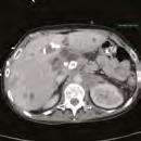 A CT of the abdomen revealed a mass in the hilum of the liver and an indeterminate lesion in the left lobe of the liver.