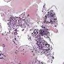 Onsite cytopathology confirmed the lesion to be a metastatic cancer. Performing trans-duodenal FNAs at EUS can be technically challenging.