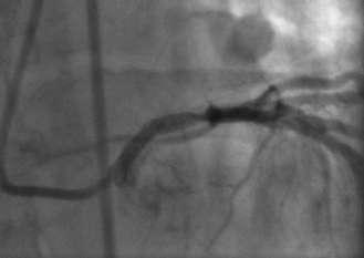 CASE: High surgical risk 81 yr old, severe CAD with USA and needs CABG.