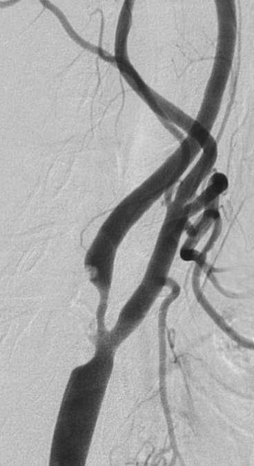 CAE and CAS CAE 56 yrs old and the most studied vascular operation in history of