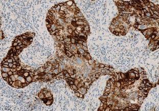 PD-L1 is a Critical Source of Immune Suppression in Cancer: