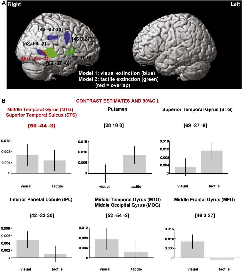 M. Chechlacz et al. / NeuroImage: Clinical 2 (2013) 291 302 297 Fig. 2. Grey matter substrates of left visual and left tactile extinction in strokes affecting only the MCA or PCA vascular territory (VBM Analysis 2; n=262).