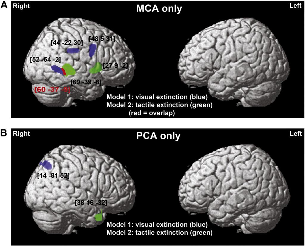 298 M. Chechlacz et al. / NeuroImage: Clinical 2 (2013) 291 302 Table 3 Grey matter substrates of visual and tactile extinction (VBM Analysis 2: MCA and PCA strokes).