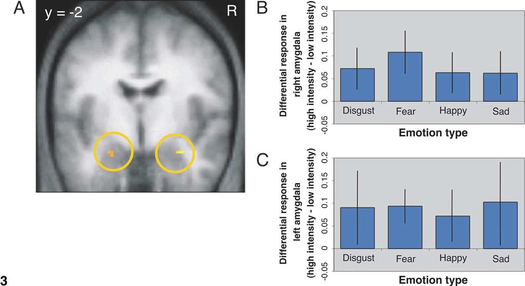 Fig. 3. Amygdala response common to different facial emotions.