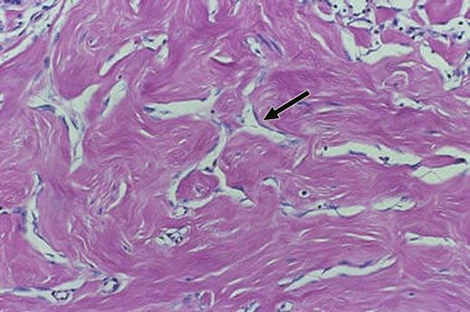 attenuated spindle cells interspersed between normal breast glandular tissue.