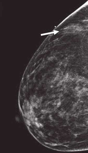 Jones et al. Fig. 3 45-year-old woman with extensive lobular carcinoma of left breast.