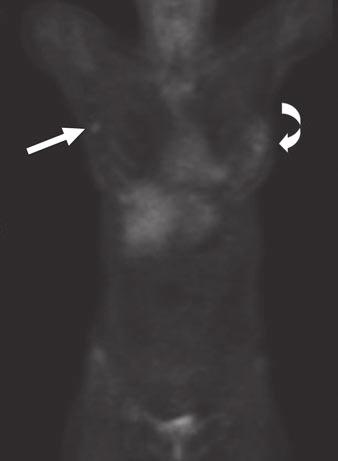 right outer breast (arrow).