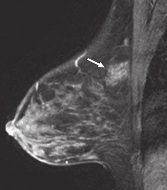 asymmetric density seen mammographically and of similar intensity to left breast cancer (curved arrow).