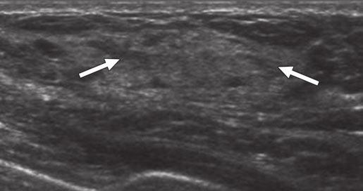 administration, of contralateral right breast shows clumped nonmasslike enhancement in asymmetric tissue in right upper
