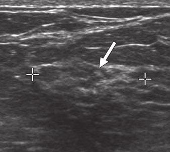 (arrow), which has increased since screening mammogram 2 years previously.