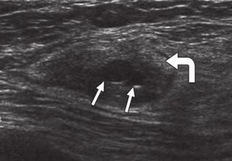mammographic asymmetric density. Fig. 5 44-year-old woman with pseudoangiomatous stromal hyperplasia.