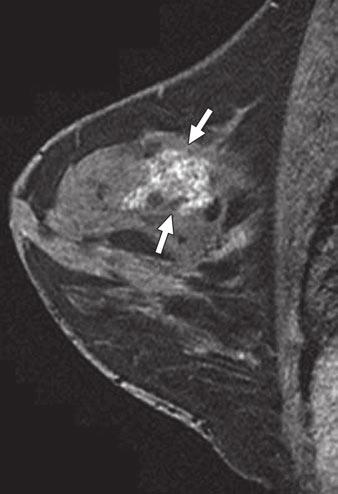 Jones et al. Fig. 6 35-year-old woman with prior left mastectomy for rhabdomyosarcoma.