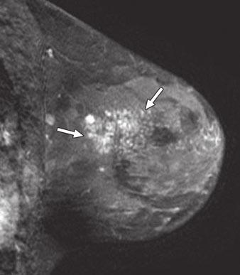 linical follow-up for 3 years was negative for malignancy; however, patient elected to have prophylactic mastectomy.
