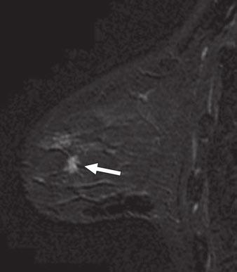 7 50-year-old woman with biopsy-proven ductal carcinoma in situ of right breast.