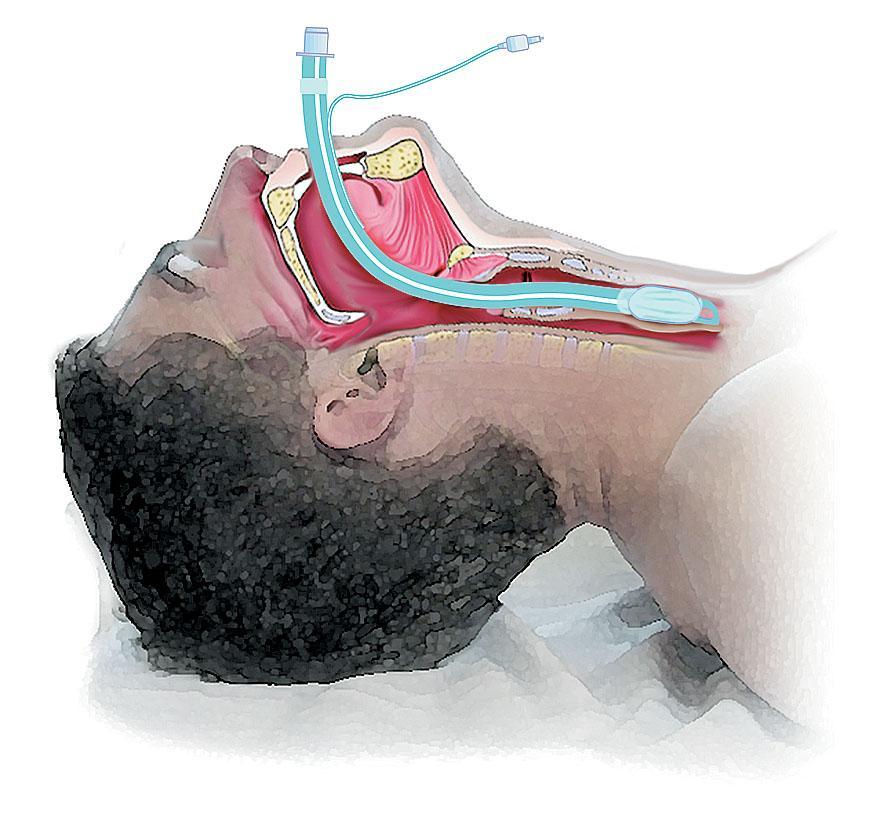 Oral Endotracheal Tube Fig. 1-8.