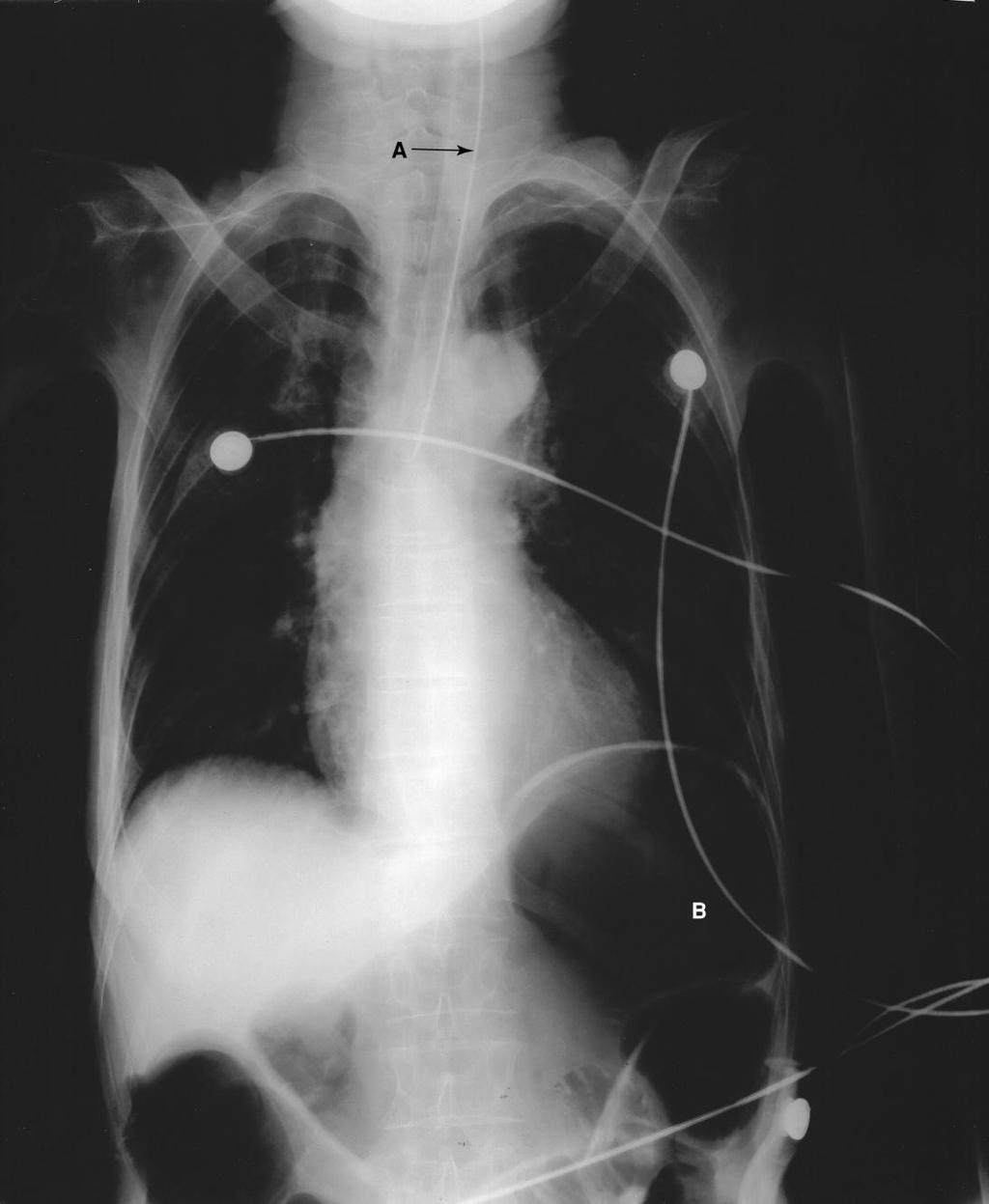 Misplaced Endotracheal Tube Fig. 1-10. A.