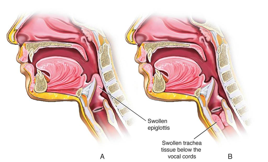 Croup Syndrome Fig. 1-12. Croup syndrome. A.