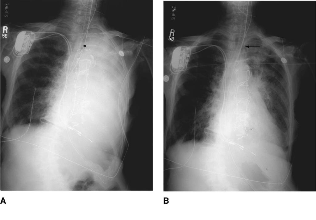 Endotracheal Tube in Right Main Stem Fig. 1-22. A.