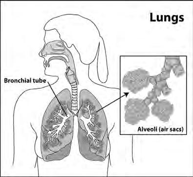 Examples of lung diseases are: Asthma, chronic bronchitis, and emphysema Infections, such as influenza and pneumonia Lung cancer Sarcoidosis (sar-koy-doh-sis) and pulmonary fibrosis Lung disease is a