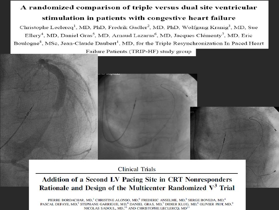J Am Coll Cardiol 2008;51:1455-62 Hypothesis: CRT with 1 RV + 2 LV leads in opposite