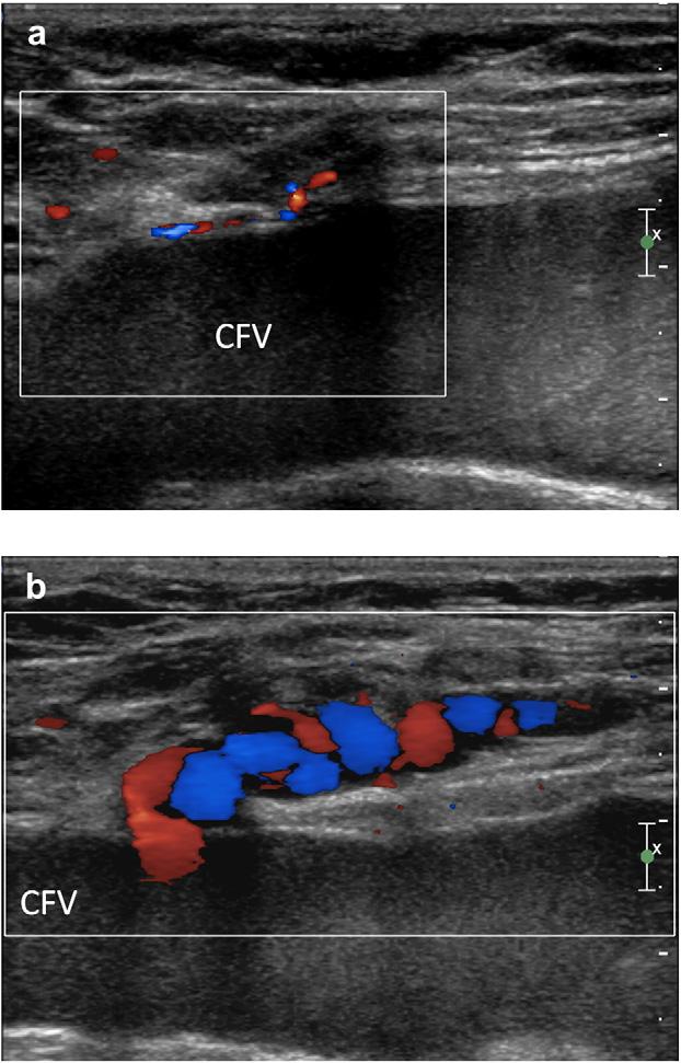 Figure 1 (a) Network of tiny refluxing veins originating from the common femoral vein (CFV) in the high ligation area suggesting angiogenesis (neovascularisation).