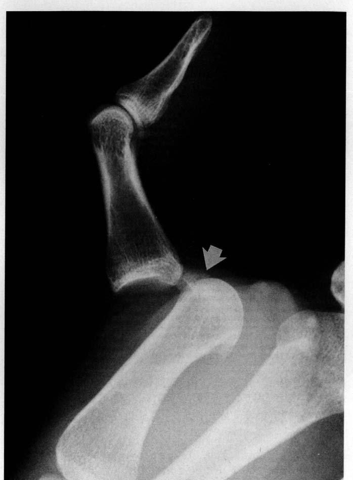 338 Figure 4. Normal anatomy of the thumb metacarpophalangeal joint.