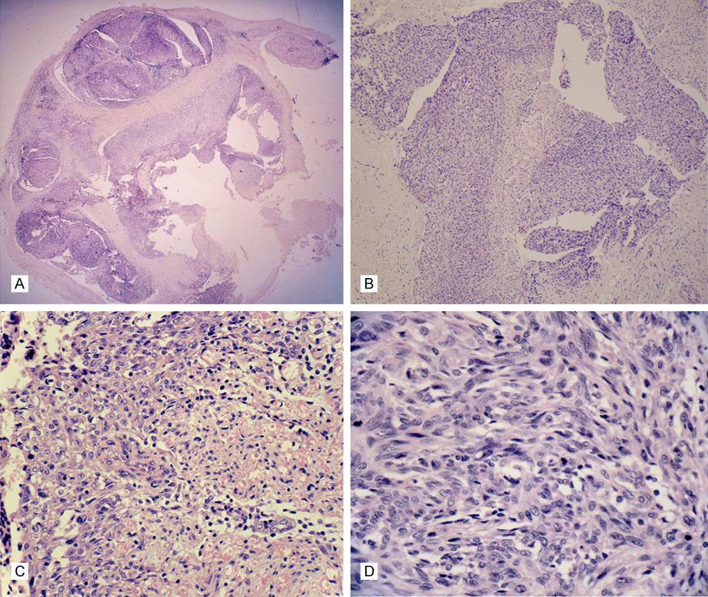 Figure 1. Histological appearance of malignant perineurioma. A: At scanning magnification, the mass were wellcircumscribed, unencapsulated, multi-nodular located in median nerve.