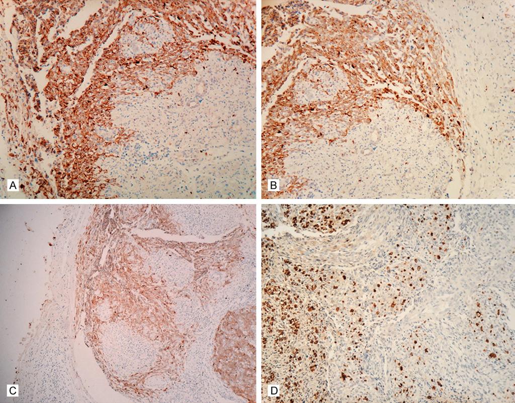 Figure 2. Immunohistochemical staining of malignant perineurioma. A: The primary tumor cells were positive for cytokeratin. B: The tumor cells were positive for epithelial membrane antigen.