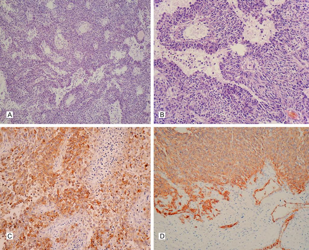 Figure 3. Histoligical and immunohistochemical changes of recurrent malignant perineurioma.