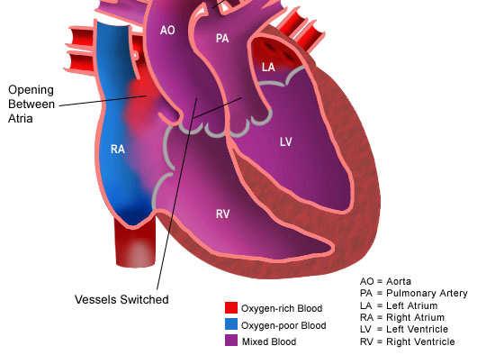 Transposition of the Great Arteries Complex cyanotic CHD due to parallel circulations. Extreme cyanosis at birth.