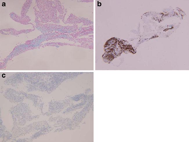 b High magnification ( 600) shows an admixture of chronic inflammatory cells, including histiocytes (h), lymphocytes (l), plasma cells (p), and occasional eosinophils (e), with histiocytes