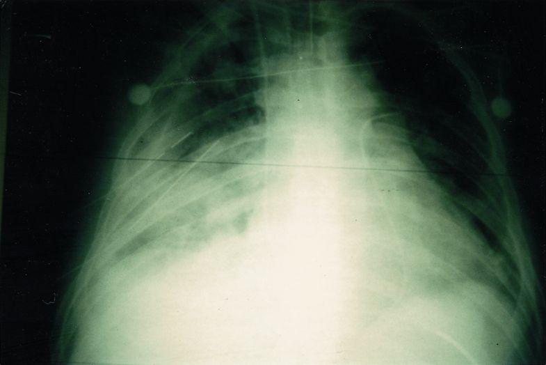 Invasive pulmonary Aspergillis