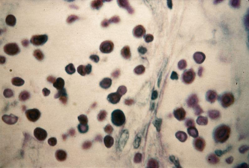 Cryptococcus neoformans yeast cells in the liver of a patient with disseminated cryptococcus 29 Fungal Diseases Classified into 3 clinical groups 1.