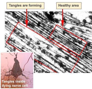 The Alzheimer s Brain: Tangles tau helps the tracks stay straight Tau