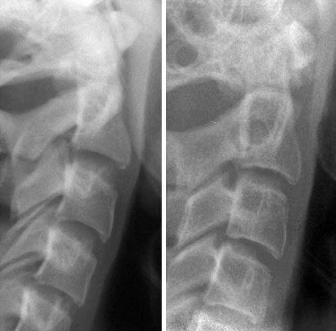 126 T. Baccetti, L. Franchi, and J.A. McNamara Figure 8 Cervical stage 6 (CS6): two clinical examples.