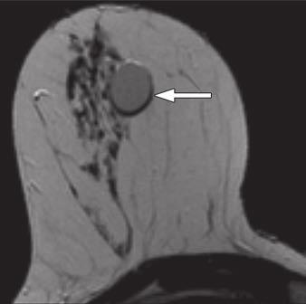 hyperintense signal in two adjacent simple cysts.