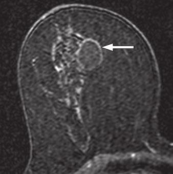 breast cancer who presented for screening MRI.