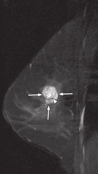 round mass with smooth margins detected on screening MRI.